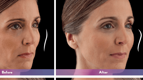 Model with Before and After Vo